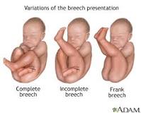 Image result for icd 10 code for breech baby