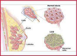 How does breast cancer start? Recurrent Breast Cancer Modern Cancer Hospital Guangzhou China