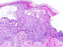 Herpes simplex virus (hsv) is a common cause of infectious esophagitis. Pathology Outlines Herpes Simplex Zoster