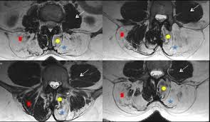 La myopathie des ceintures était devenue, pour reprendre un terme cher à michel fardeau, un diagnostic « fourretout », assurément commode en pratique clinique mais sans spécificité aucune et souvent entaché d'erreurs. Centre D Imagerie Osteo Articulaire Clinique Du Sport De Bordeaux