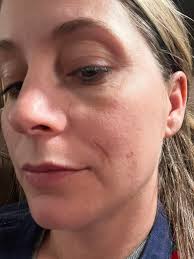 My husband recently had skin cancer surgery. The area at his neck was super  invasive. He has two stitched areas at least 5” long each. Thankfully after  four passes they got it