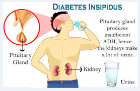 Diabetes Insipidus Google Search Diabetes Insipidus Diabetes In Children Endocrine Disorders