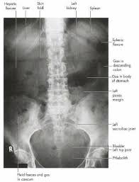 Abdomen X Ray X Ray Abdomen Fit Board Workouts