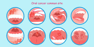 Image result for dental cancer