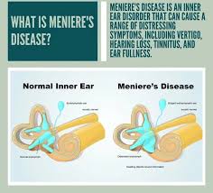Image result for Inner Ear Decompression Sickness