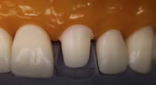 Pfm medical is a globally active industrial medical technology company with headquarters in cologne. Pfm Preparation On Anterior Tooth University Of Toronto Faculty Of Dentistry Information And Instructional Technology Services