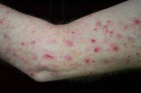 Image result for Neurotic Excoriation