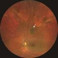 Image result for nevus sclerae