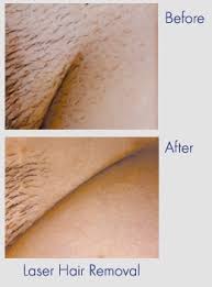 See a demonstration of a laser hair removal treatment with expert skin care tips in this free hair removal video clip.expert: Does Hair Regrow After Laser Hair Removal