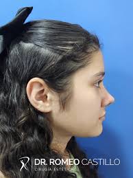 RINOPLASTIA ESTETICA DR ROMEO CASTILLO PÉREZ CIRUJANO ESTÉTICO CERTIFICADO  #rinoplastiaestetica #rinoplastiavillahermosa #rinoplastiatabasco  #rinoplastiamexico #rinoplasty #rinoplastia #cirugiadecara ...