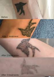 If you want an experienced consultant to remove your tattoo quickly, with the most advanced laser available, for the best possible price, give us a call on. Tattoo Removal Leamington Spa