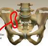 Anterior to obturator canal insertion: 1