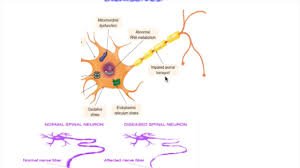 Low vitamin d deficiency exacerbates disease pathophysiology in the g93a mouse model of als.dec. Als Pathology Pathogenesis Youtube