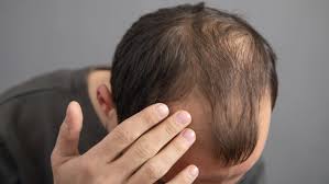 Hair Loss (Alopecia) in Men - Causes, Prevention and Self Care Tips