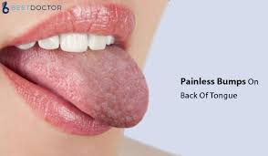 Sensitive + enamel shield, cph healthy fresh Painless Bumps On Back Of Tongue Causes Treatment Home Remedies