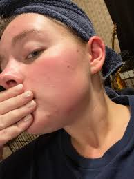 Is it safe to use the Anti-Blemish product line while pregnant?