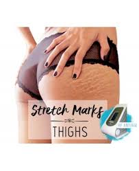Developed designed for the stretch marks of mommy before and after the birth, it contains mango essence and a variety of plant nutrition repair ingredients, which is easy to the skin looks softer and fairer. Stretch Marks Removal With Rf Antiage