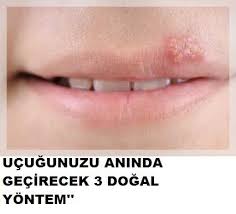 Ucugu Aninda Gecirecek 3 Dogal Yontem Bagisiklik Sistemi Saglik Dogal