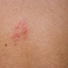 Image result for shingles