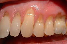Image result for Tooth Abrasion