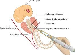 Image result for Periapical Block