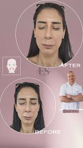 Фейслифтинг