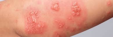 Image result for Pemphigoid
