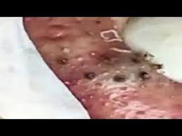 Huge Acne Pimples Youtube In 2020 Acne And Pimples Acne Pimples