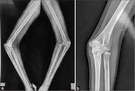 Image result for Radial Head Dislocation