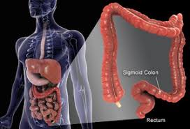 A personal history of polyps and inflammatory bowel diseases, including ulcerative colitis and crohn's colitis. Colorectal Cancer Physiopedia