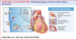 Image result for Post-MI Pericarditis
