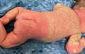 Image result for scabies norvegica