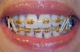 Black And White Braces Color Gold Search On Indulgy Com Braces Colors Cute Braces Gold Braces