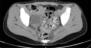 Residual Ovarian Syndrome A Case Report With Classic Symptoms Imaging And Pathology Findings And Treatment Sciencedirect