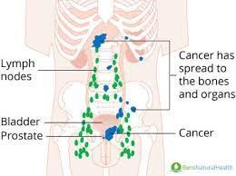 Bones, liver, and lungs are the most common sites for prostate cancer metastasis. Metastatic Prostate Cancer A Beginner S Guide Advanced