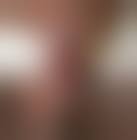 Image result for Urethral Prolapse