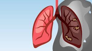 Image result for Lung Cancer