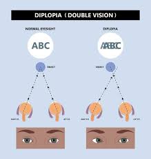 Image result for Diplopia