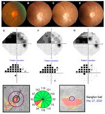 Image result for Visual Field Deficit
