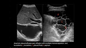 The procedure failures or ultrasound guidance is strongly recommended when attempting to aspirate any pleural effusion. Pin By Dr Abuaiad On Pediatrics Pleural Effusion Pediatrics Medical