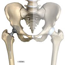 What is the best material to use for hip replacement. Artificial Joint Replacement Of The Hip Anterior Approach Eorthopod Com