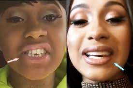 Cardi B Teeth Before And After Photo Compare In 2021 Cardi B Plastic Surgery Celebrity Plastic Surgery