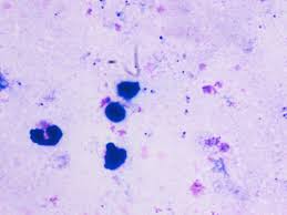 Image result for Stool Leukocytes