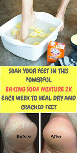 Soak Your Feet In This Powerful Baking Soda Mixture 2x Each Week To Heal Dry And Cracked Feet Excellent Remedies In 2020 Cracked Feet Dry Cracked Feet Cracked Skin