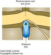 Degenerative Disc Disease In Dogs Degenerative Disc Degenerative Disc Disease Disc