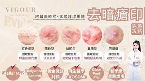 暗瘡印｜正確家居護理步驟！消炎＋去痘印的醫美重點