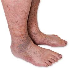 Image result for Pigment stains on the shin
