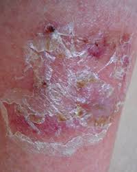 Image result for Eczema nummulare