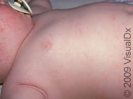 Image result for sweat rash on back baby