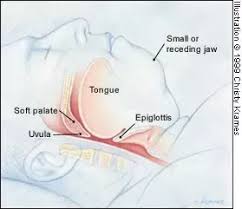 How to stop snoring — and when to see a doctor about dangerous nighttime breathing. What Are Some Methods Proven To Reduce Or Completely Stop Snoring Quora